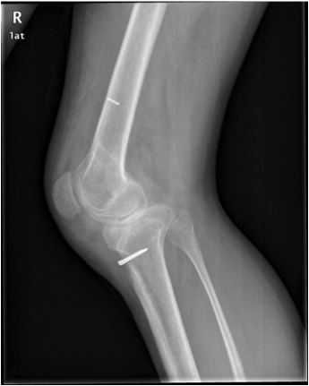 Infected ACL Lateral